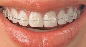 ارتودنسی دندان چیست و انواع ارتودنسی