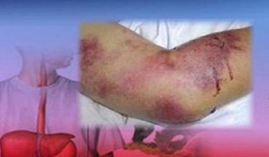  شناسایی 10 مورد مشکوک به تب کریمه کنگو در یزد